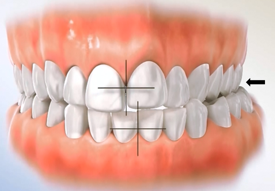 lateral crossbite